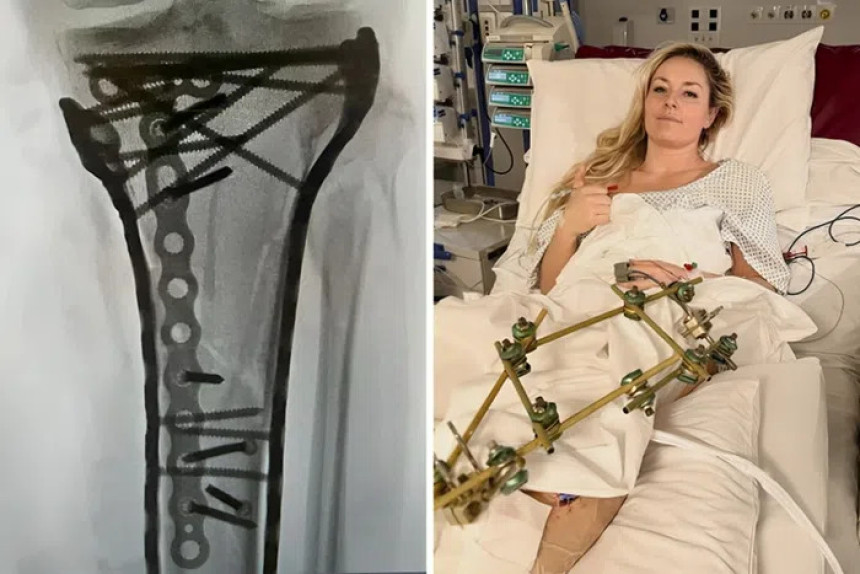 Šraf do šrafa: Ovako sada izgleda noga Lindzi Von (VIDEO)