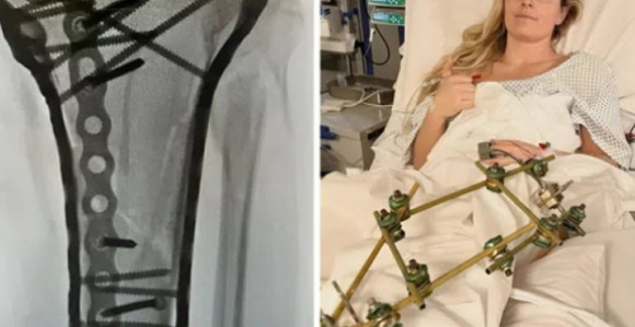 Šraf do šrafa: Ovako sada izgleda noga Lindzi Von (VIDEO)