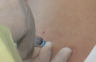 Djetetu u Banjaluci greškom data pogrešna vakcina
