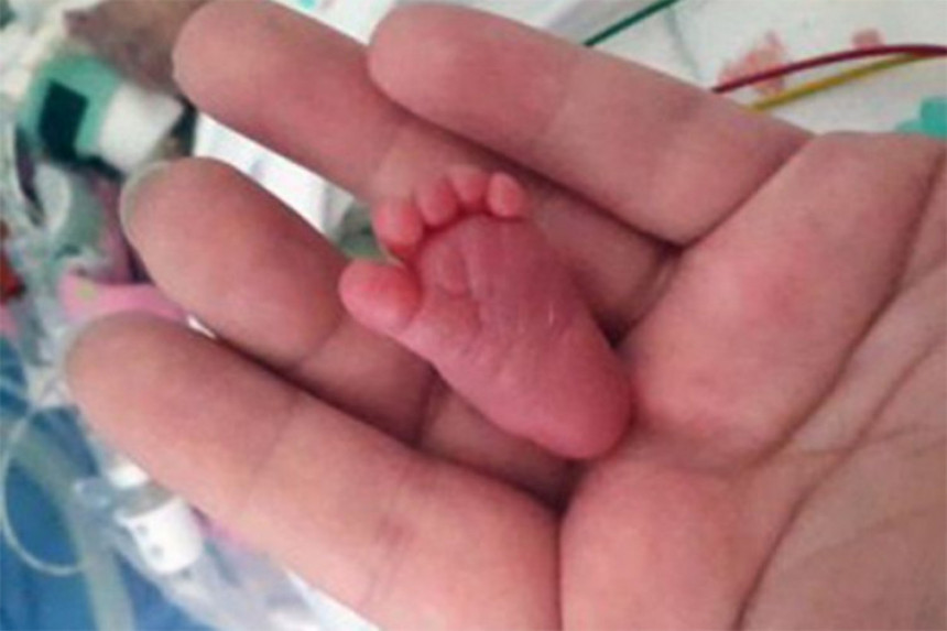 Беба од 400 г се изборила за живот