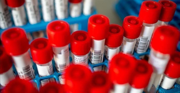 U Srpskoj 152 slučaja korone, 33 osobe preminule